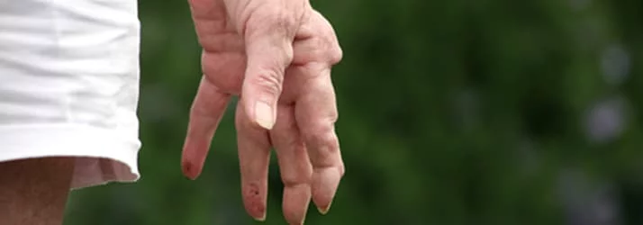 arthritis elderly woman's hand